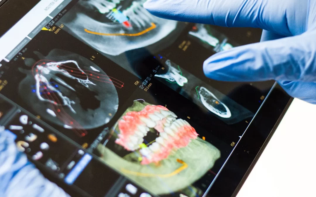 Periodontite –sintomas e sinais de alerta