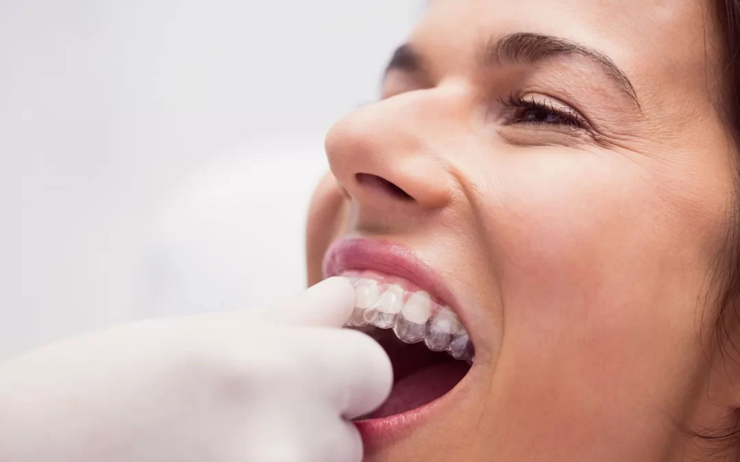 Aparelho invisível – alinhe os dentes sem ninguém dar por isso