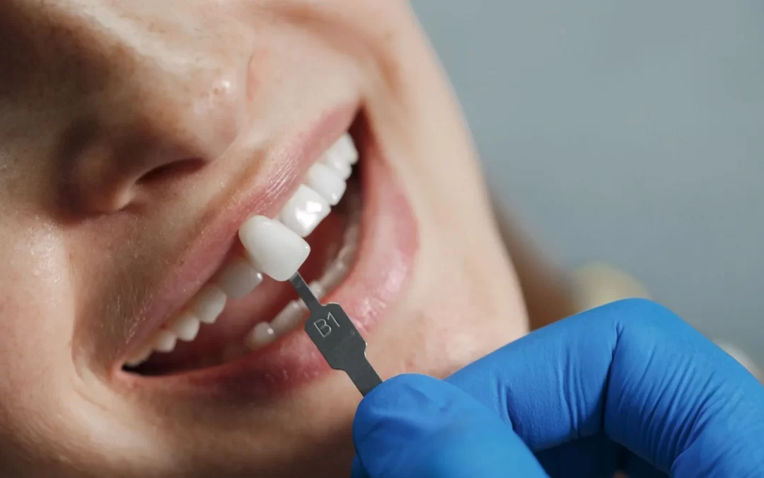 Facetas dentárias – uma solução rápida para imperfeições e diastemas