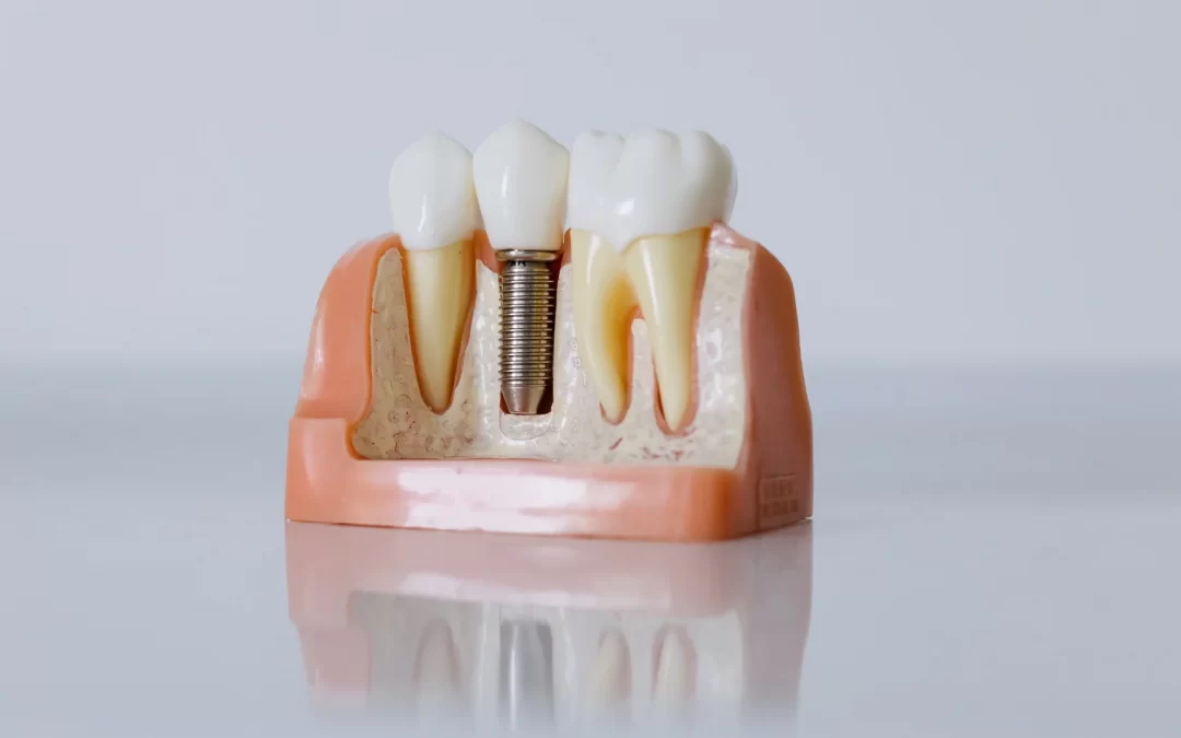 Implante dentário – colocação de “dente fixo” no próprio dia