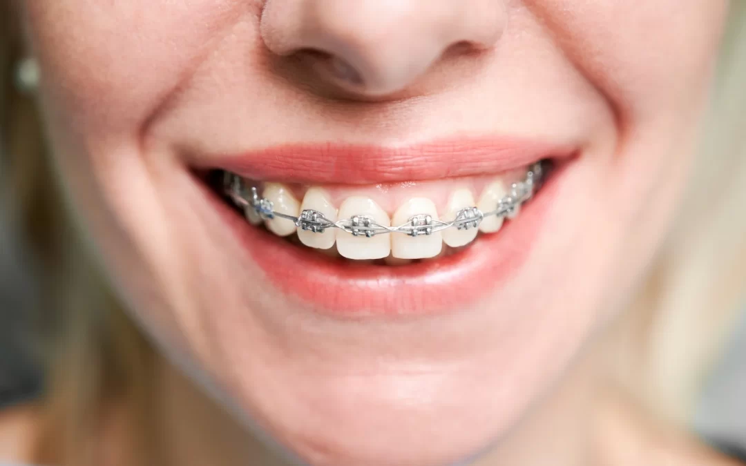 Aparelho dentário – tipos e características