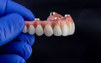 Implante dentário – fases do tratamento