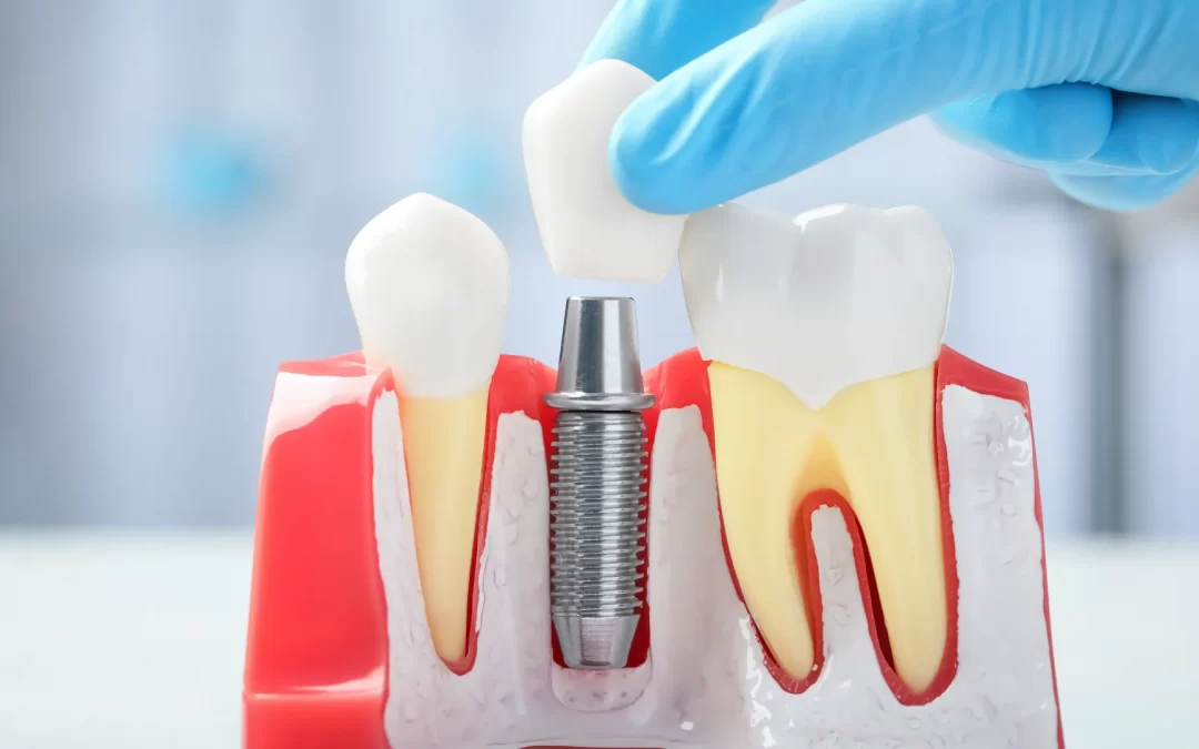 Higienização implantes dentários